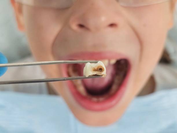 Emergency Dental Filling Replacement in MO